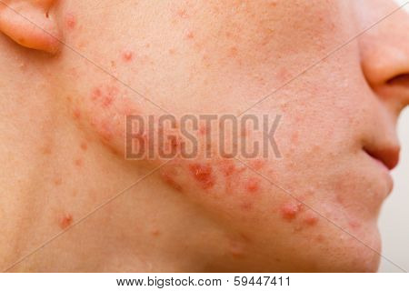 Acne Skin