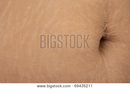 Stretch Marks