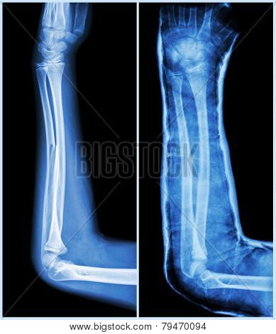 Fracture Shaft Of Ulnar Bone ( Forearm Bone )