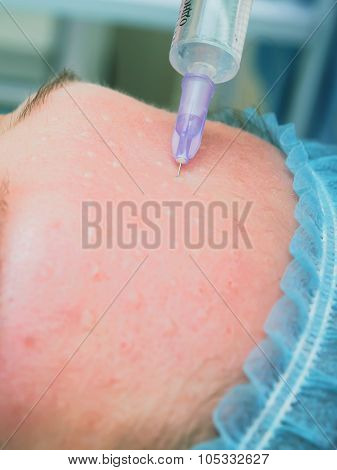 Cosmetology procedure mesoteraphy. Rejuvenation revitalization, skin nutrition, wrinkle reduction. D