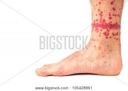 Flea Bites