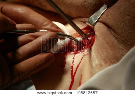 Bleeding Wound During The Surgery