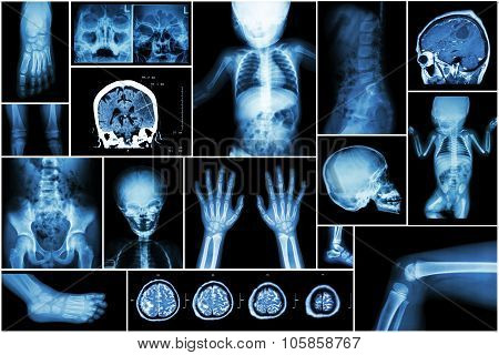 X-ray Multiple Part Of Child 's Body & Multiple Disease