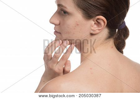 Beautiful young girl with red and white acne on her face. Before and after cream with sponge. Stop acne on a white background.