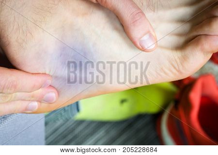 Bruise near foot ankle common runners contusion.