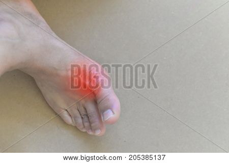 Painful And Inflamed Gout..