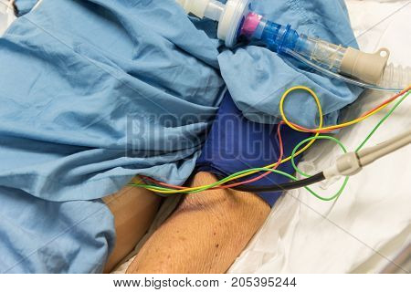 Patient Do Tracheostomy And Ventilator In Hospital