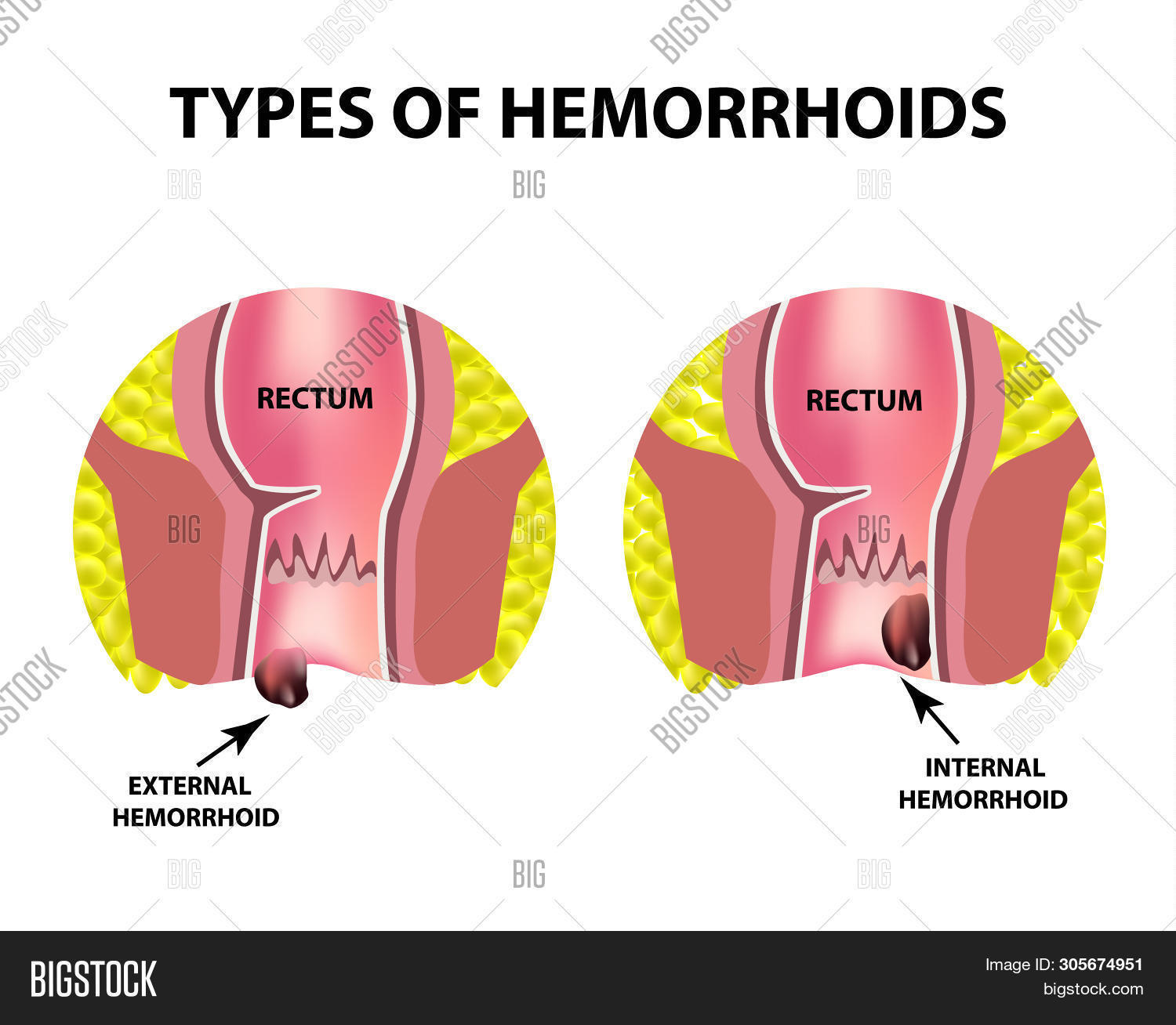 Two Types Hemorrhoids Image & Photo (Free Trial) | Bigstock