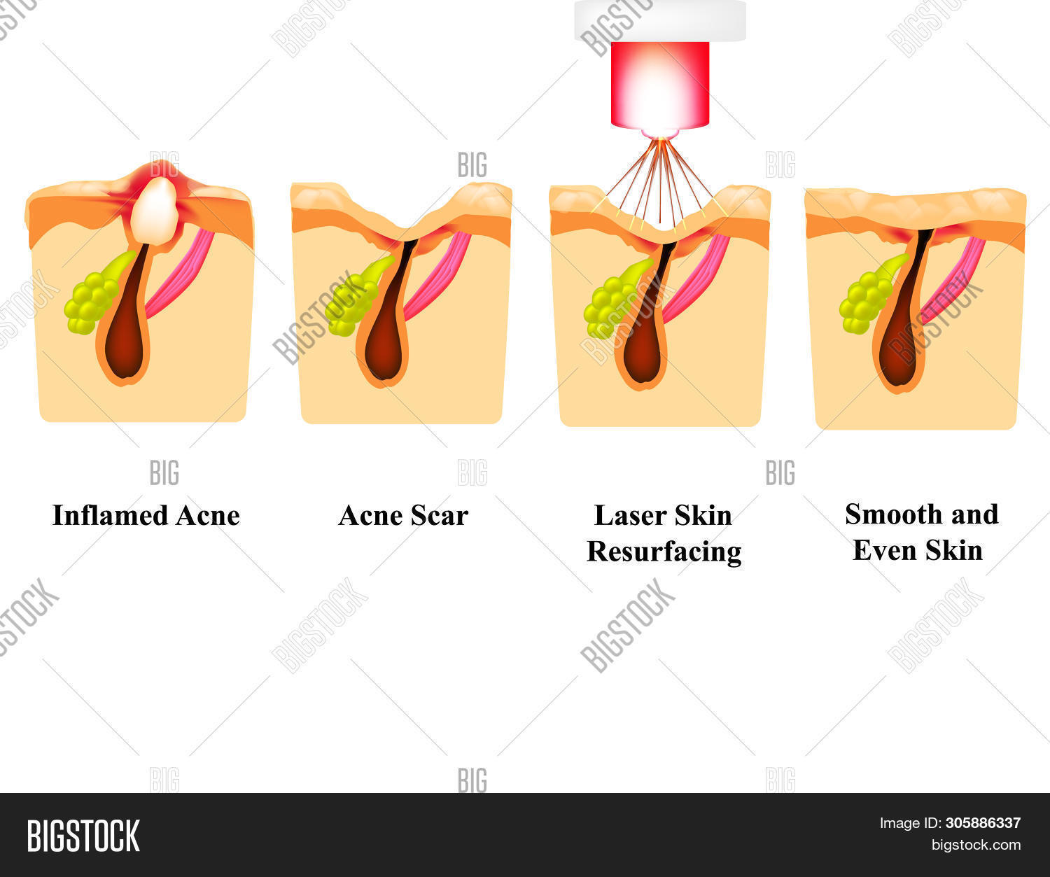 Inflamed Acne On Skin Image & Photo (Free Trial) | Bigstock