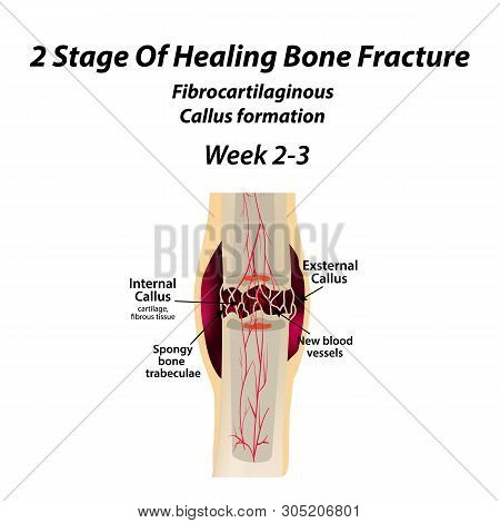 2 Stage Of Healing Bone Fracture. Formation Of Callus. The Bone Fracture. Infographics. Illustration