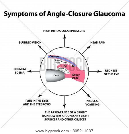 The Symptoms Of Closed Angle Glaucoma. World Glaucoma Day. The Anatomical Structure Of The Eye. Info