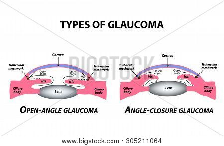 Types Of Glaucoma. Open-angle And Angle-closure Glaucoma. The Anatomical Structure Of The Eye. Infog