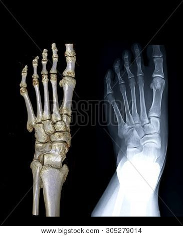 Comparison Of Left Foot Ap View 3d Rendering Image And X-ray Image For Diagnostic Fracture And Gouty