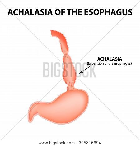 Achalasia Of The Esophagus. Expansion Of The Esophagus. Hernia. Infographics. Illustration On Isolat