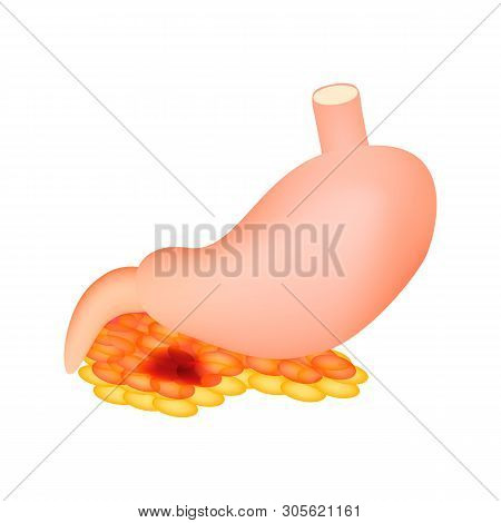 Pancreatitis. The Structure Of The Stomach And Pancreas. Infographics. Illustration On Isolated Back