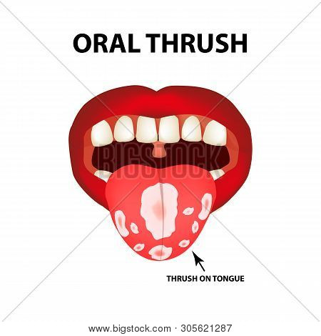 Oral Thrush. Candidiasis On The Tongue. Fungus In The Mouth. Infographics. Illustration On Isolated 