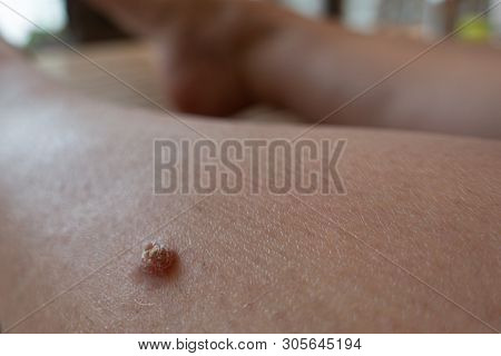 An Unattractive Wart Has Formed On The Shinbone