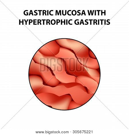 Gastric Mucosa With Hypertrophic Gastritis. Infographics. Illustration On Isolated Background