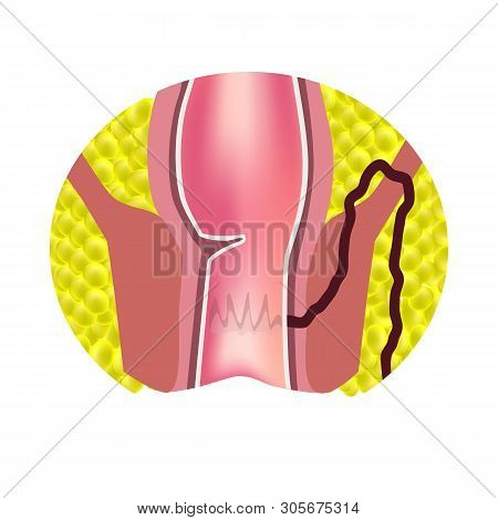 Types Of Fistulas Of The Rectum. Paraproctitis. Anus. Abscess Of The Rectum. Infographics. Illustrat