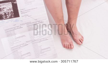 Doctor Holds Ultrasound Results Of Varicose Veins In An Elderly Woman, White Background, Close-up, P
