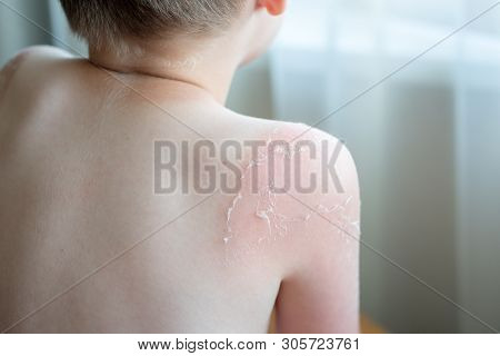 Sunburnt On Skin Around Knee Of Mans Left Leg, Isolated On White Background