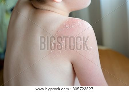 Sunburnt On Skin Around Knee Of Mans Left Leg, Isolated On White Background