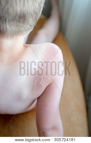 Sunburnt On Skin Around Knee Of Mans Left Leg, Isolated On White Background