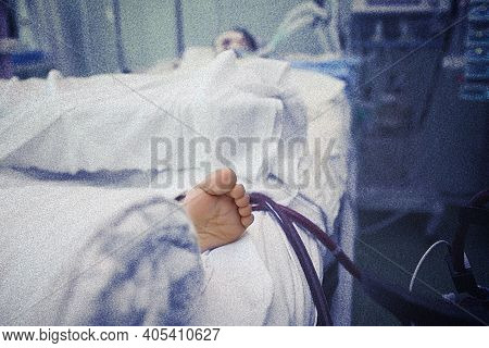 Patient In The Icu Connected To Mecanical Ventilator And Hemodialysis Apparatus.
