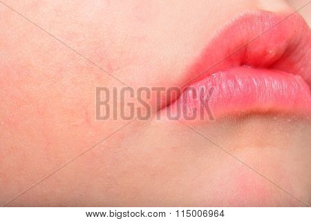 Atopic Dermatitis