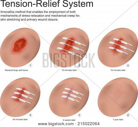 A wound is a type of injury which happens relatively quickly in which skin is torn, cut, or punctured or where blunt force trauma causes a contusion.