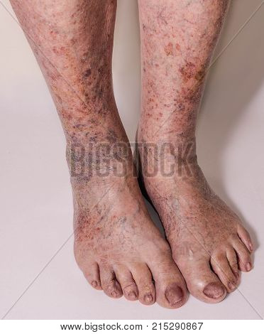 Close-up of skin with varicose veins on senior male leg. Concept of dry skin