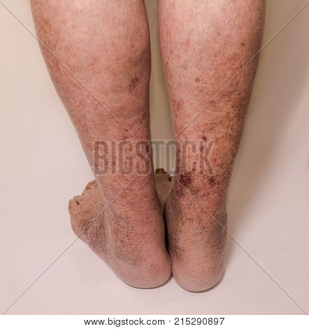 Close-up of skin with varicose veins on senior male leg. Concept of dry skin