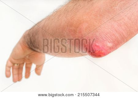 Detailed View Of Elbow With Carbuncle Or Furuncle
