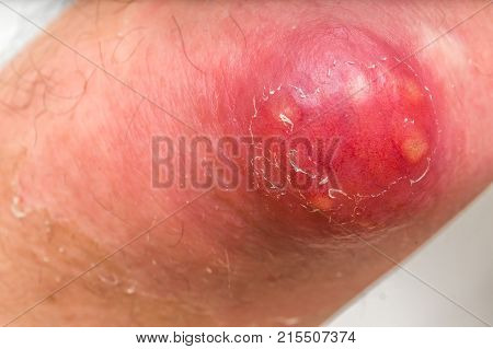 Detailed View Of Elbow With Carbuncle Or Furuncle