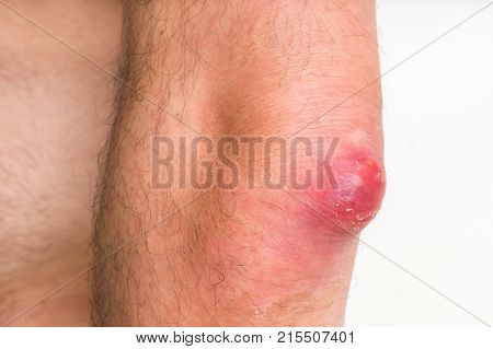 Detailed View Of Elbow With Carbuncle Or Furuncle