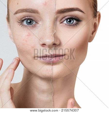 Comparison portrait of old photo with acne and healthy skin of young girl. Skincare concept.