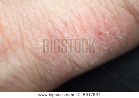 Hand dermatitis. Hand eczema closed on white background