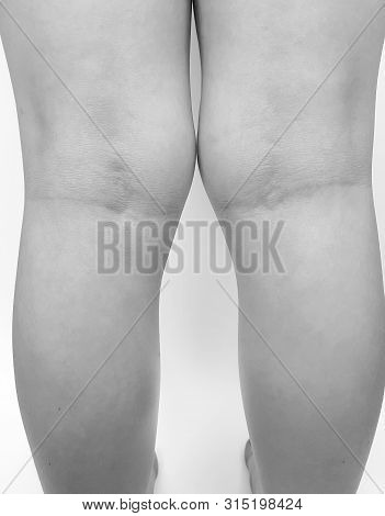 Deformation Valgus Knee Leg Child Background  Medicine