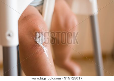 Decontamination And Disinfection Of The Wound On Baby Knee At Home. Close Up