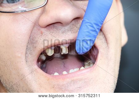 The Man Has Rotten Teeth, Teeth Fell Out, Yellow And Black Teeth Hurt. Poor Teeth Condition, Erosion