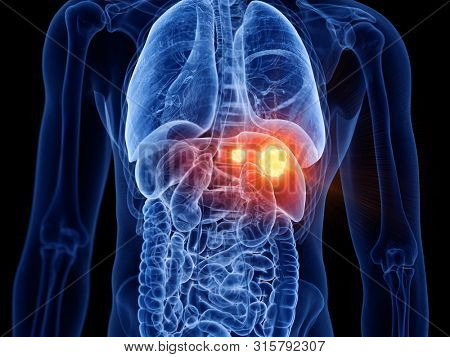 3d rendered medically accurate illustration of liver cancer