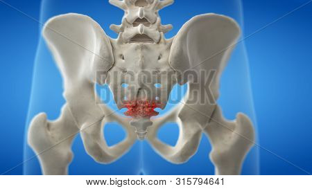 3d rendered medically accurate illustration of an arthritic coccyx