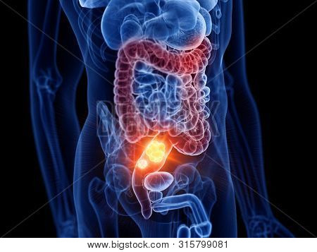3d rendered medically accurate illustration of colon cancer