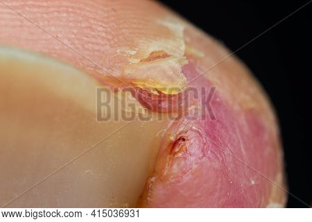 Macro Photo Of An Ingrown Fingernail In The Healing Period