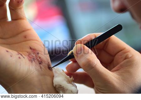 Abrasions On The Palm And Scratches On The Right Arm Of An Adult Man. Home Treatment.
