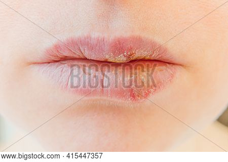 Close Up Of Girl Lips Affected By Herpes. Treatment Of Herpes Infection And Virus. Part Of Young Wom