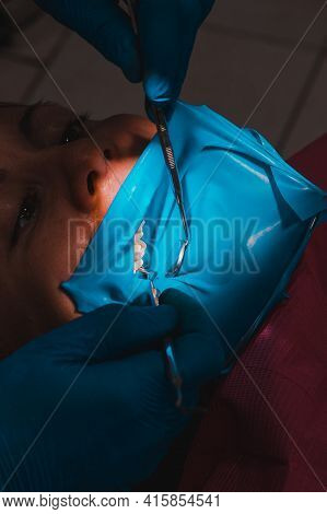 Dental Procedure, Treatment Of The Upper Masticatory Tooth, Modern Dental Treatment With A Rubber Da