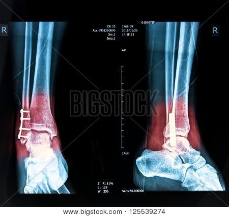 human foot right ankel xray picture with plate and screws