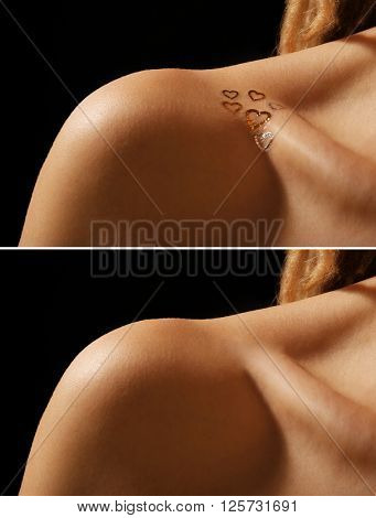 Tattoo on woman collarbone. Laser tattoo removal concept