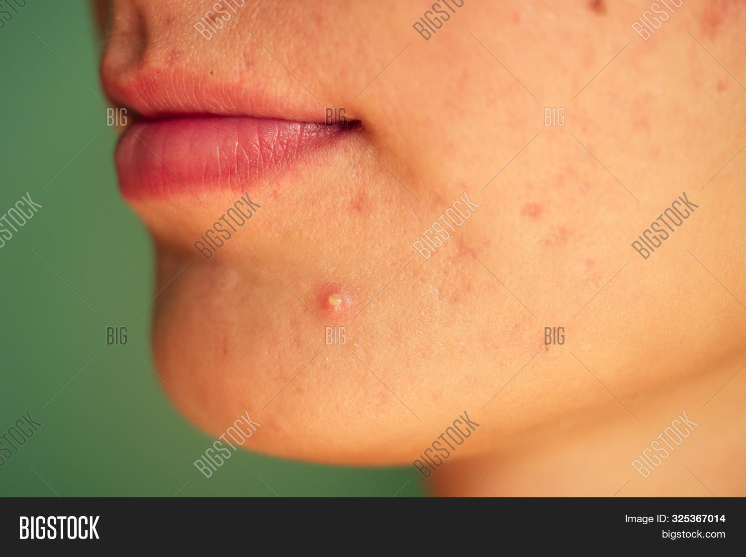 Postacne, Scars Red Image & Photo (Free Trial) Bigstock